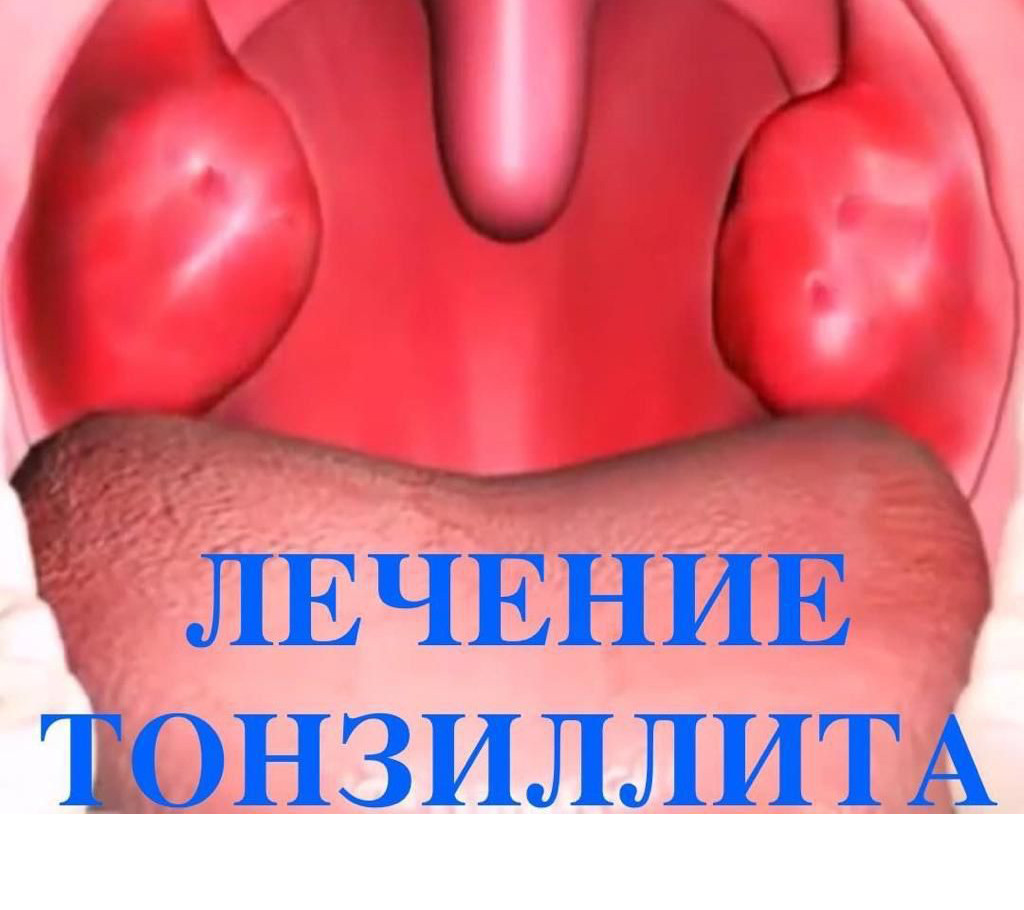 Лечение хронического тонзиллита