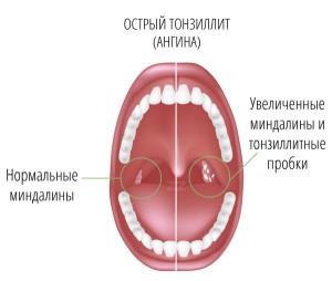 Тонзиллит